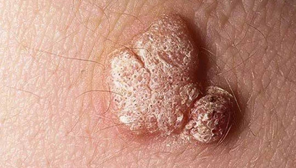 HPV é a principal causa do câncer do colo de útero e pode levar até 20 anos para se manifestar