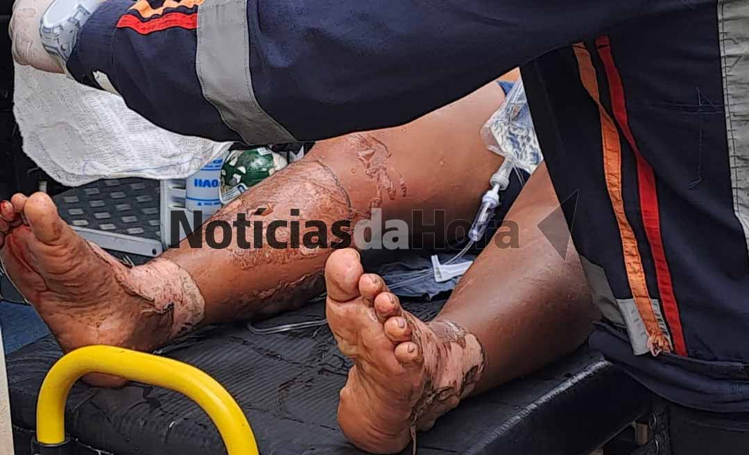 Colisão entre motocicletas no Ramal do Rodo deixa quatro pessoas com queimaduras graves; motos pegaram fogo