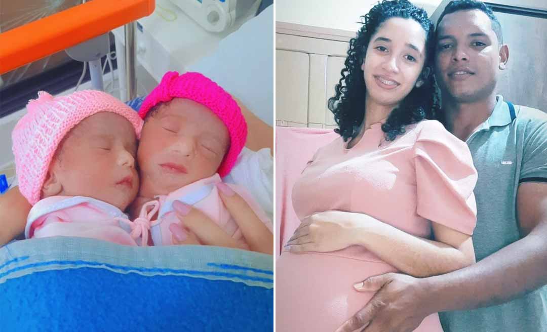Gêmeas siamesas ligadas por um coração desafiam prognóstico médico: Elas estão no oxigênio e se alimentam por sonda"