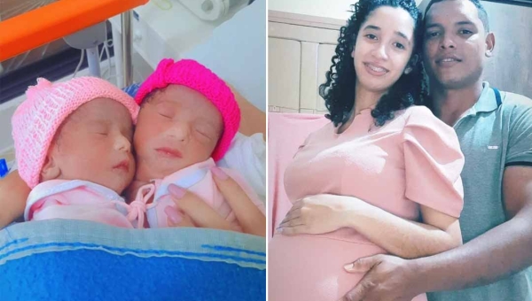 Gêmeas siamesas ligadas por um coração desafiam prognóstico médico: Elas estão no oxigênio e se alimentam por sonda"