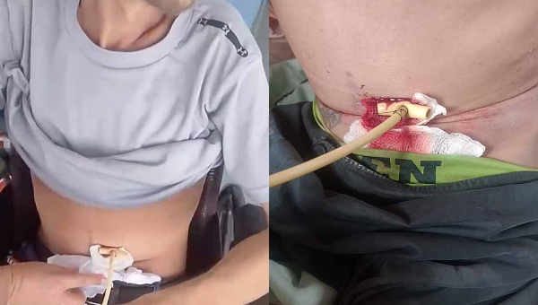 Paciente oncológico morre após denúncias de negligência e abandono no UNACON