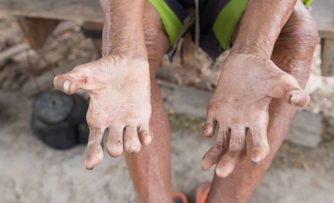 Hanseníase tem cura: campanha nacional reforça importância do diagnóstico precoce