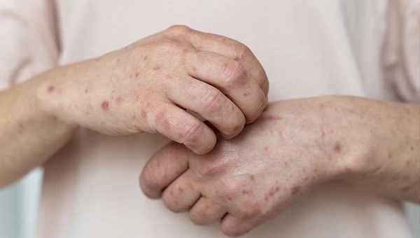 Confirmação de quatro casos de Mpox em Porto Velho acendem alerta e colocam Acre em atenção contra o vírus