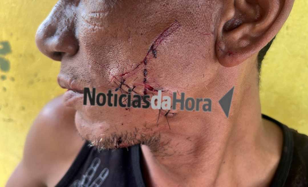 Homem sofre cortes profundos no rosto após ser atacado por mulher com garrafa em Manoel Urbano